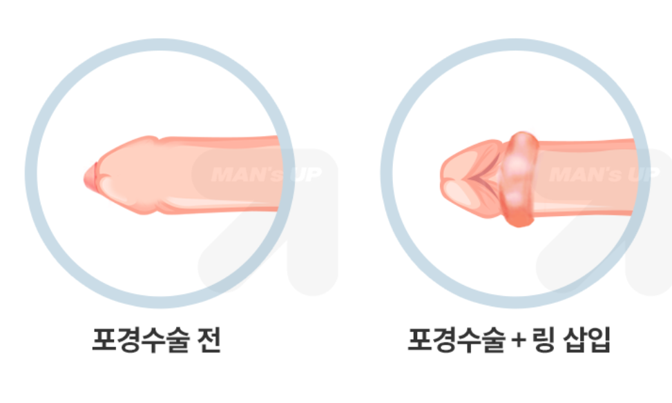 포경수술과 다른 남성수술 병행 참고 이미지