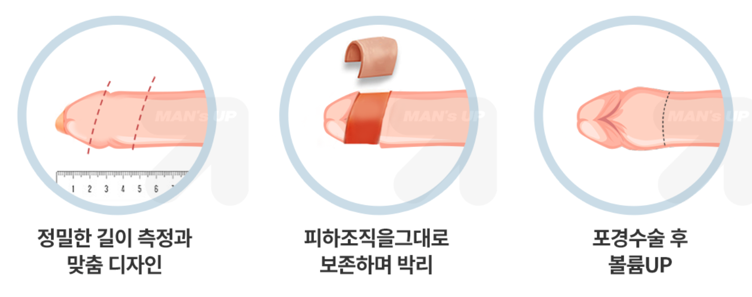 볼륨업 포경수술 과정 참고 이미지
