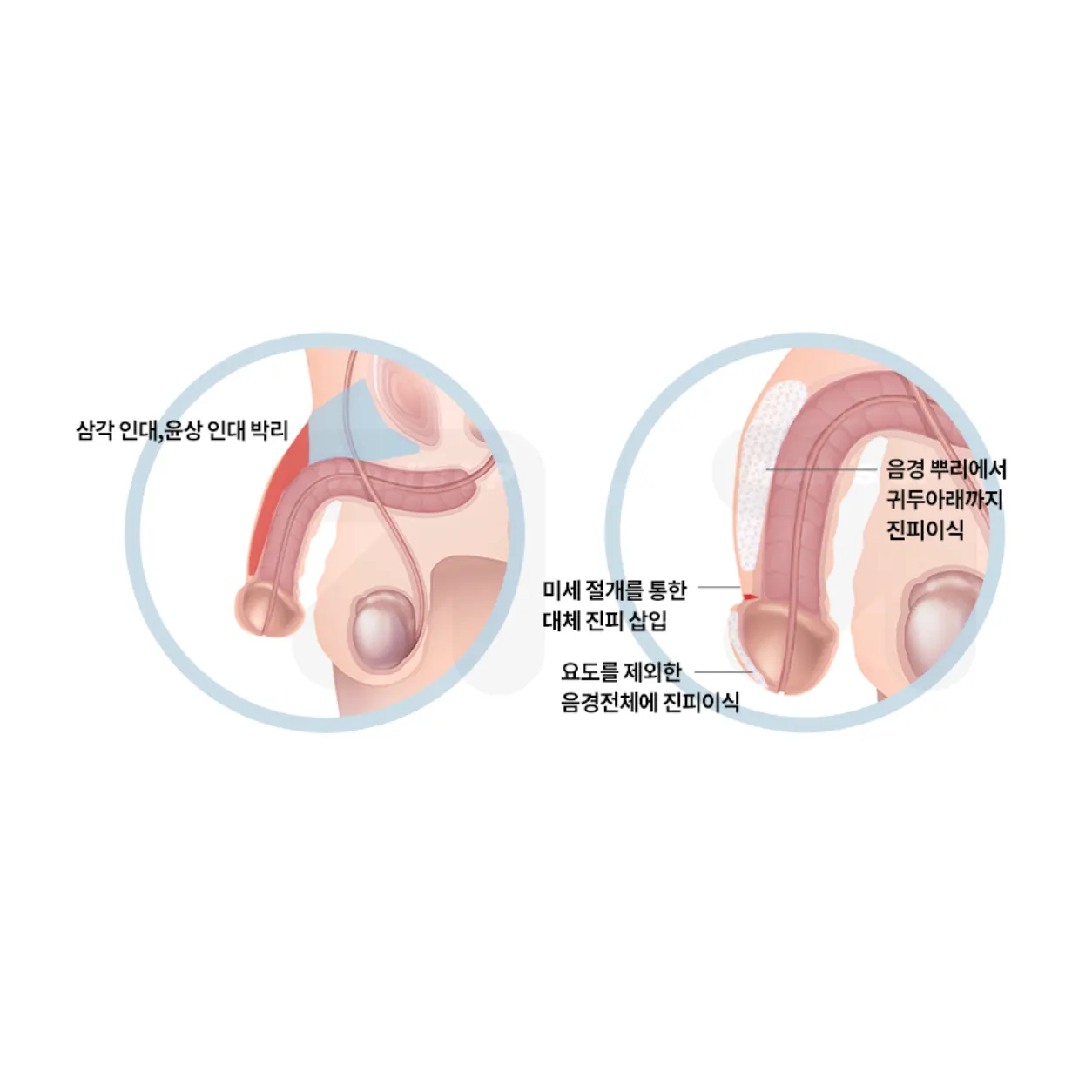 맨즈업 복합수술 음경확대 안내 이미지