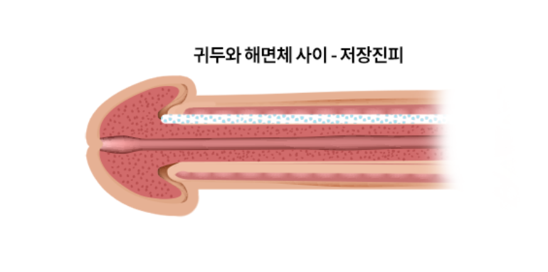 저장진피 귀두확대술 참고 도식