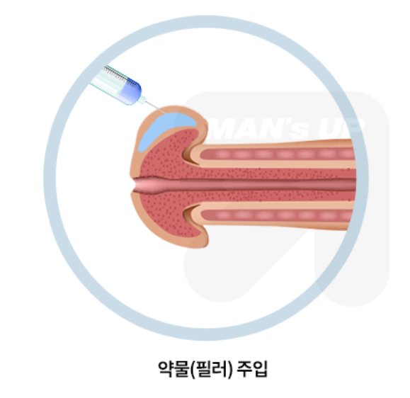 필러 귀두확대술 참고 이미지