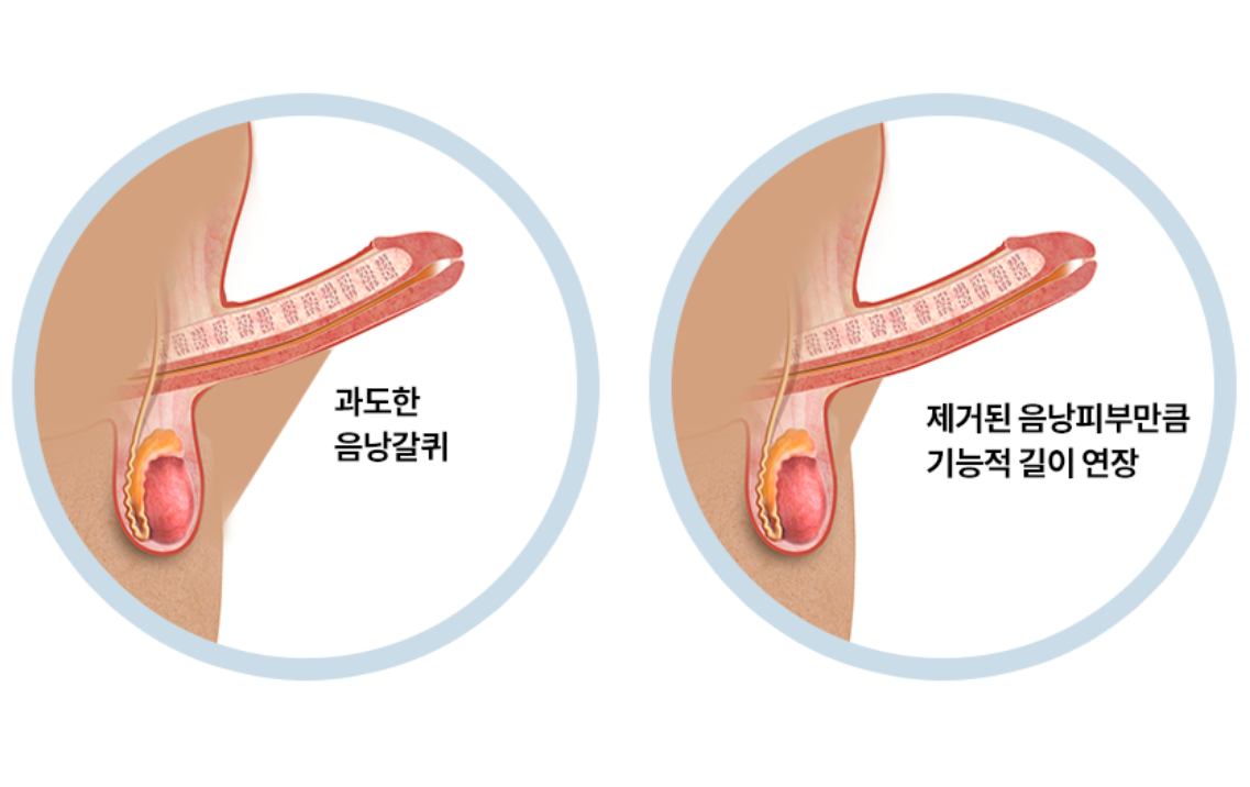 음낭갈퀴성형술 참고 도식