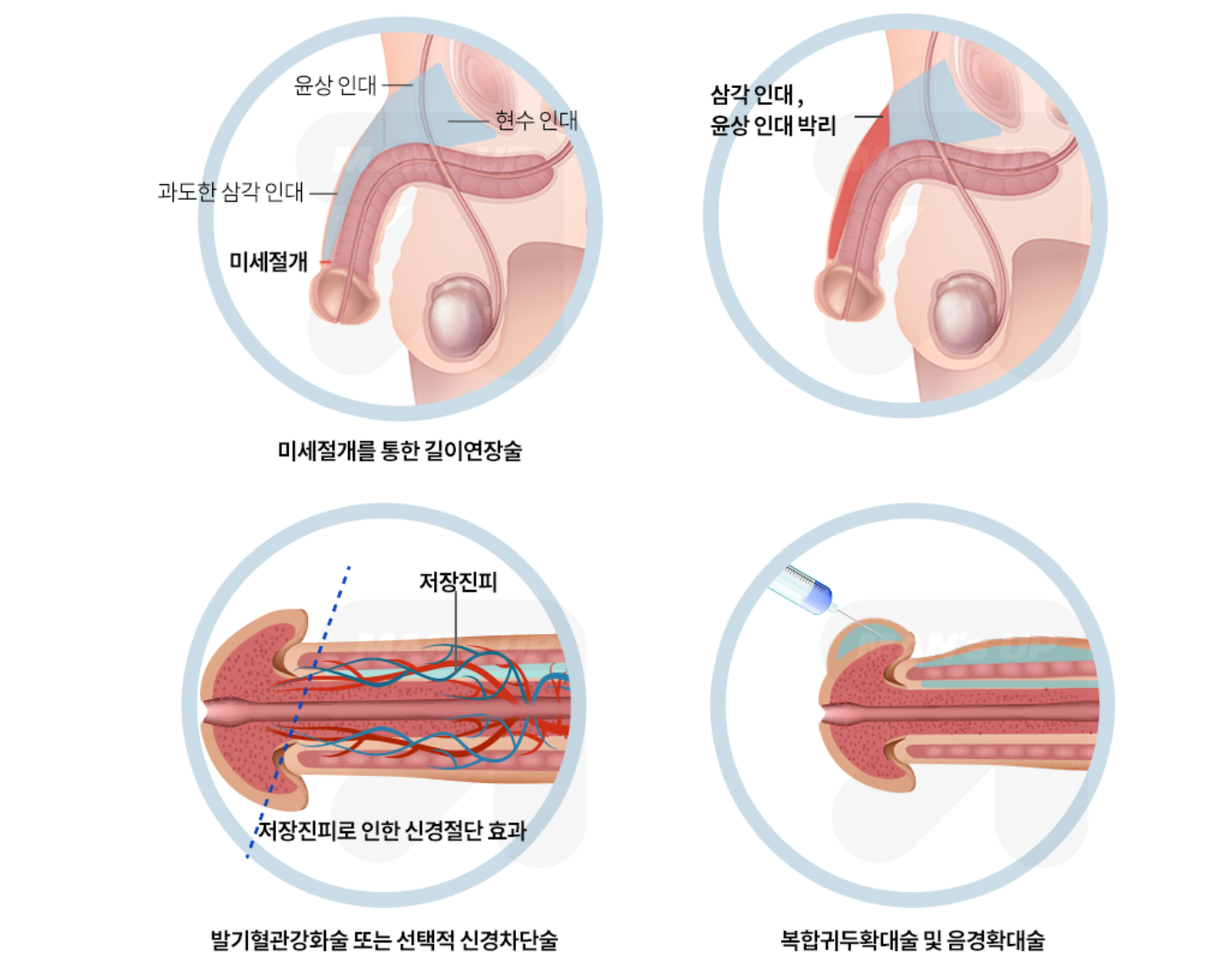 오감만족 복합수술과 음경둔화술 참고 이미지